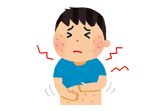 麻疹の症状 発疹期