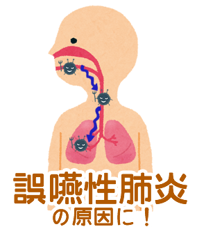 口腔内細菌が誤嚥性肺炎の原因に