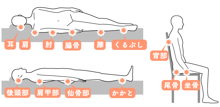 床ずれの症状が出やすい箇所